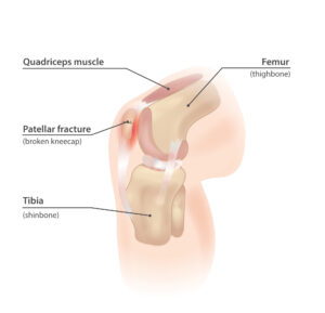 Patellar fracture