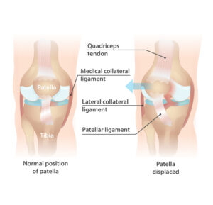 Patellar dislocation