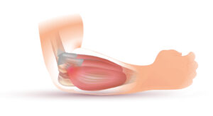 Elbow pain