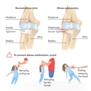 Elbow subluxation