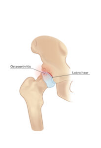 Hip Osteoarthritis