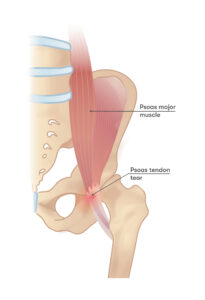 Psoas tendon tear