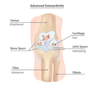 Knee Osteoarthritis