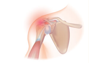 Rotator cuff injury