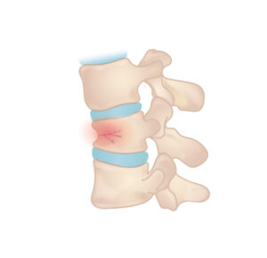 Spine injury