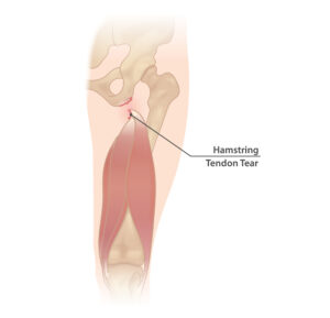 Hamstring tear