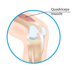 Quadriceps tendon