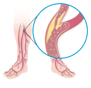 Peripheral artery disease