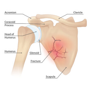 Scapula fracture