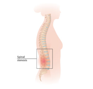 Spinal stenosis A