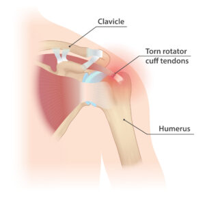 Rotator cuff injury